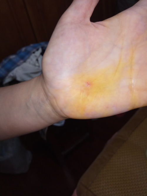 没有伤口的伤,没有伤口的伤真的好痛是什么意思