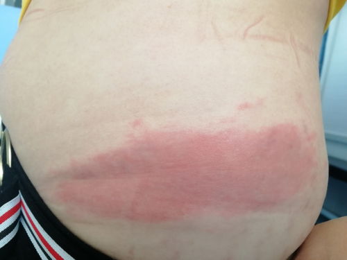 皮疹,皮疹是什么