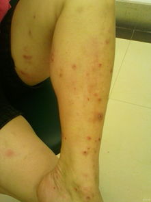 皮疹是什么,皮疹是什么