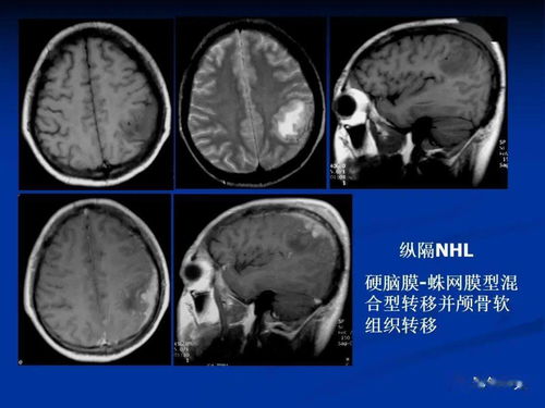 脑膜,脑膜的意思 脑膜的意思是什么